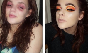 Mlada blogerica otkrila ekcem na licu i poručila 'Ja nisam svoje stanje'